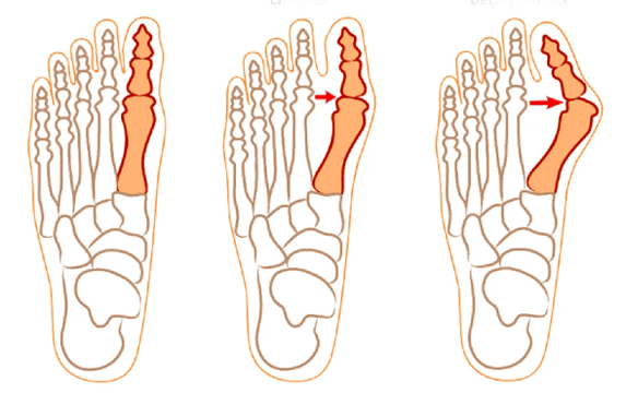 Hallux-valgus-Deformität