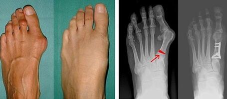 Symptome eines Hallux Valgus