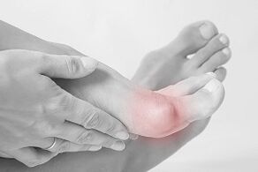 Hallux valgus, wie man Schuhe auswählt
