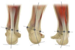 Normaler Fuß mit Valgus- und Varusabweichung des Fersenbeins