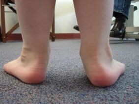 Plattfuß-Valgusdeformität bei einem Kind