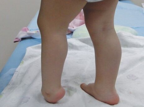Die ersten Symptome der Valgus del Pieda Deformation